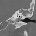 Cholesteatoma (Radiopaedia 9408-10093 Coronal bone window 4).jpg