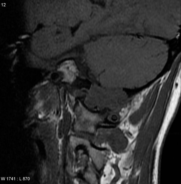 File:Chondroblastoma - occipital condyle (Radiopaedia 5569-7306 Sagittal T1 1).jpg