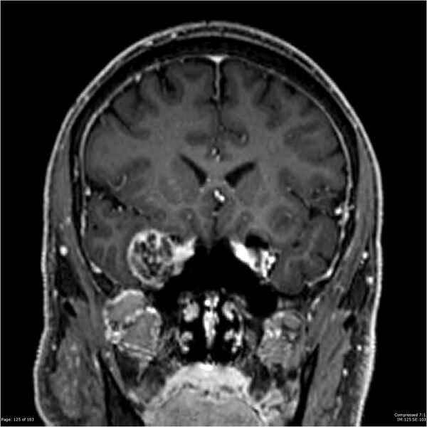 File:Chondrosarcoma of skull base- grade II (Radiopaedia 40948-43654 Coronal T1 C+ 36).jpg