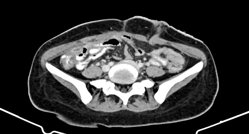 File:Choriocarcinoma liver metastases (Radiopaedia 74768-85766 A 141).jpg
