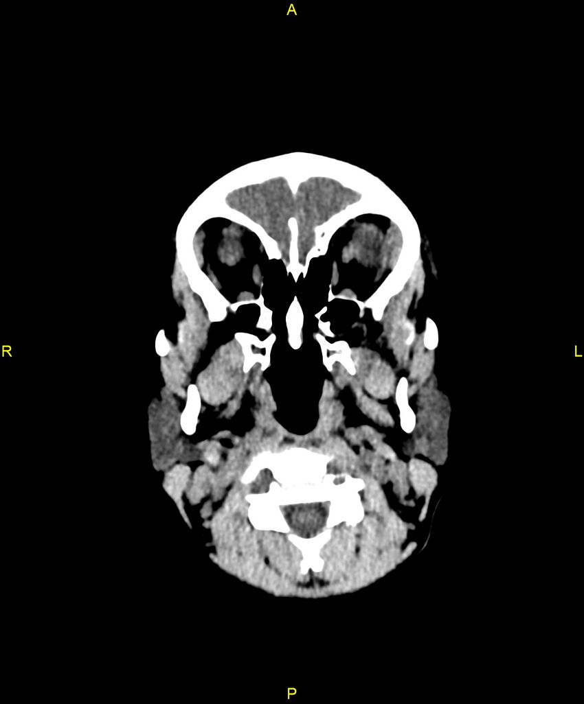 Choroidal fissure cyst (Radiopaedia 89481-106465 Axial non-contrast 12).jpg