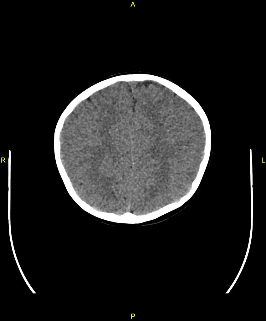 Choroidal fissure cyst (Radiopaedia 89481-106465 Axial non-contrast 90).jpg