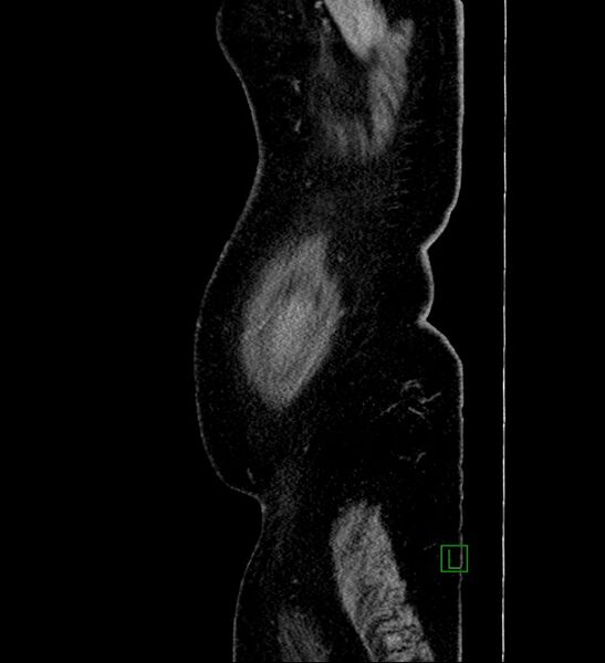 File:Chromophobe renal cell carcinoma (Radiopaedia 84239-99519 G 113).jpg
