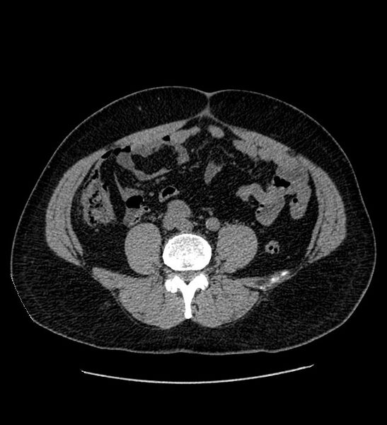 File:Chromophobe renal cell carcinoma (Radiopaedia 84337-99693 Axial non-contrast 97).jpg