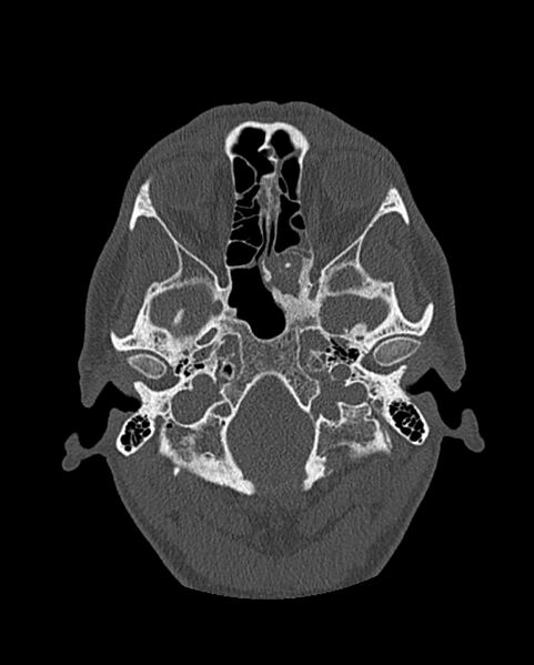 File:Chronic maxillary sinusitis caused by a foreign body (Radiopaedia 58521-65676 Axial bone window 209).jpg