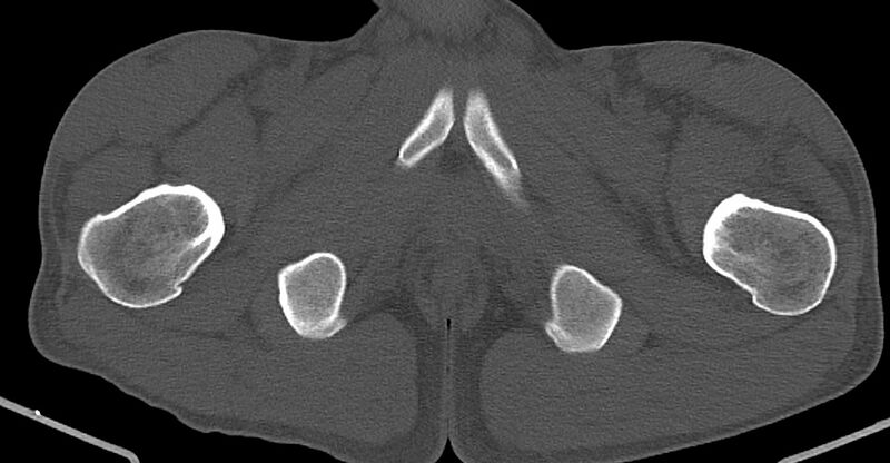 File:Chronic osteomyelitis (with sequestrum) (Radiopaedia 74813-85822 Axial non-contrast 51).jpg