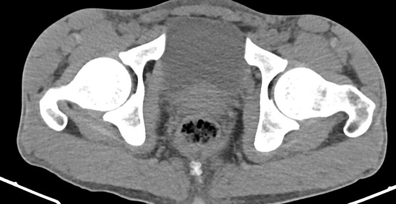 File:Chronic osteomyelitis (with sequestrum) (Radiopaedia 74813-85822 D 40).jpg