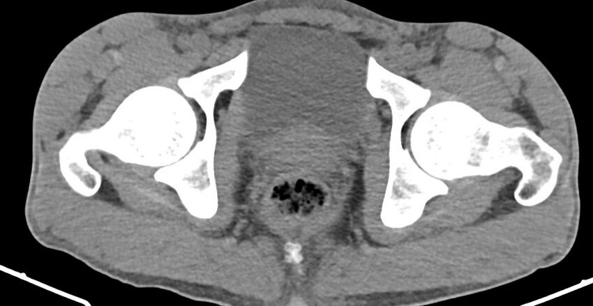 Chronic osteomyelitis (with sequestrum) (Radiopaedia 74813-85822 D 40).jpg