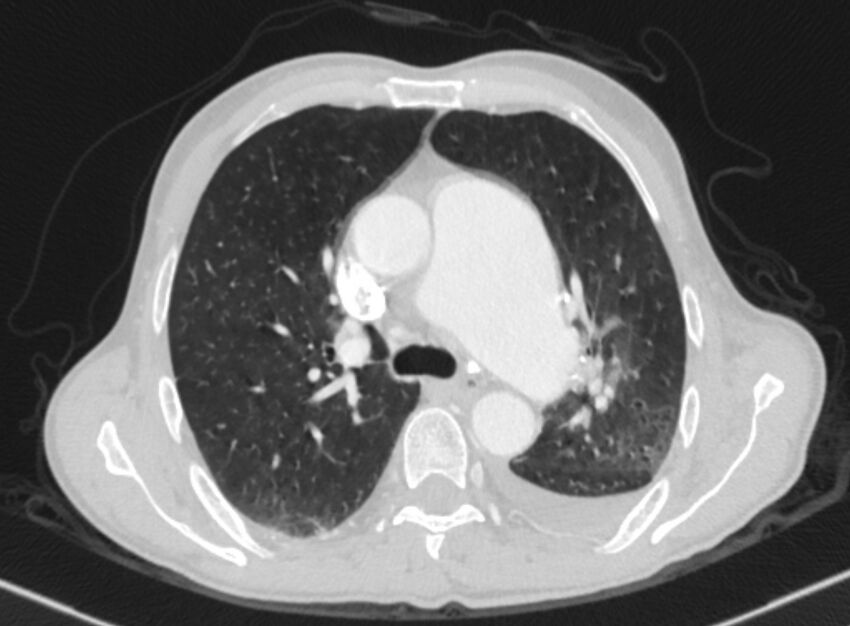 Chronic pulmonary embolism with bubbly consolidation (Radiopaedia 91248-108850 Axial lung window 62).jpg
