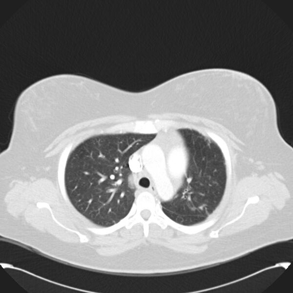 File:Chronic thromboembolic pulmonary hypertension (CTEPH) (Radiopaedia 74597-85531 Axial lung window 17).jpg