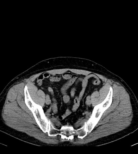 File:Clear cell renal cell carcinoma (Radiopaedia 85006-100539 Axial non-contrast 73).jpg