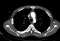 Coarctation of aorta with aortic valve stenosis (Radiopaedia 70463-80574 A 45).jpg