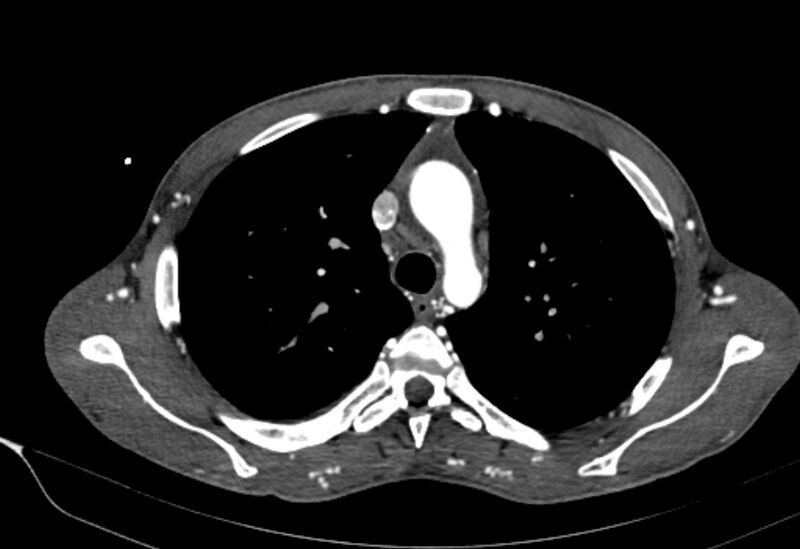 File:Coarctation of aorta with aortic valve stenosis (Radiopaedia 70463-80574 A 45).jpg