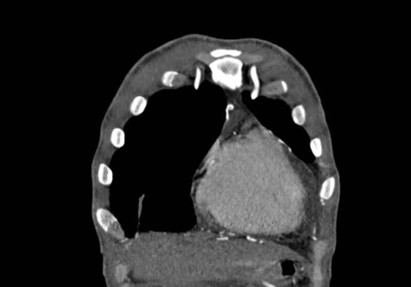 File:Coarctation of aorta with aortic valve stenosis (Radiopaedia 70463-80574 C 14).jpg