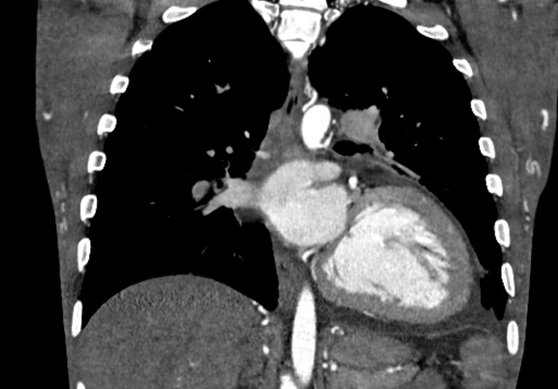 File:Coarctation of aorta with aortic valve stenosis (Radiopaedia 70463-80574 C 148).jpg