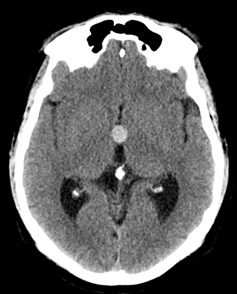 File:Colloid cyst of the third ventricle (Radiopaedia 86571-102661 Axial non-contrast 16).png