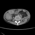 Colocolic fistula - Crohn disease (Radiopaedia 57063-63955 A 44).jpg