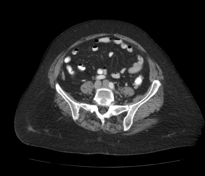 File:Colonic diverticulosis (Radiopaedia 22934-22957 A 50).jpg