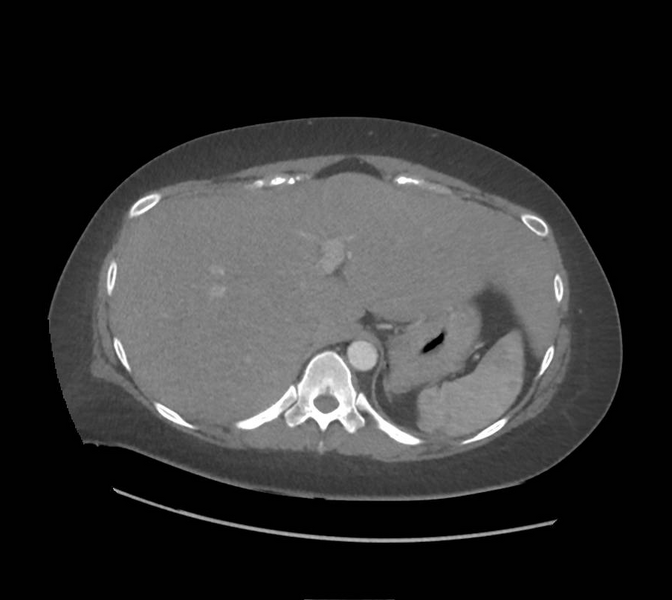 File:Colonic pseudo-obstruction (Radiopaedia 79752-92980 A 37).png