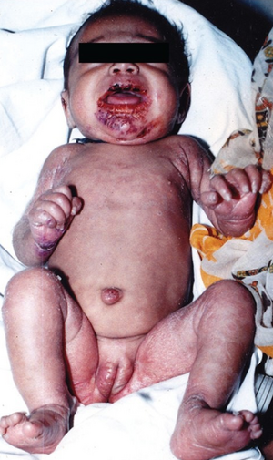 Congenital syphilis. Papulosquamous lesions with oral involvement.png