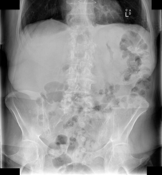 File:Gastric wall thickening - linitis plastica (abdominal x-ray) (Radiopaedia 64514).jpg
