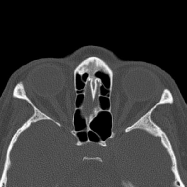 File:Nasolabial cyst (Radiopaedia 33987-35205 Axial bone window 33).jpg
