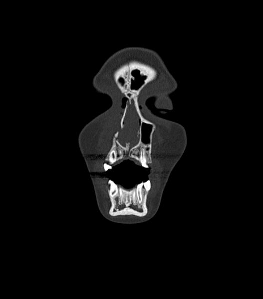 File:Nasoorbitoethmoid fracture (Radiopaedia 90044-107205 Coronal bone window 28).jpg