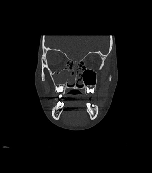 File:Nasoorbitoethmoid fracture (Radiopaedia 90044-107205 Coronal bone window 52).jpg