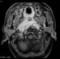 Nasopharyngeal carcinoma (Radiopaedia 4546-6667 Axial T1 C+ fat sat 10).jpg
