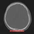 Nasopharyngeal carcinoma recurrence - skull base destruction (Radiopaedia 29107-29490 Axial bone window 41).jpg