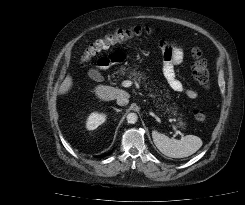 Nephroptosis with inguinal hernia containing perirenal fat (Radiopaedia 56632-63391 C 105).jpg