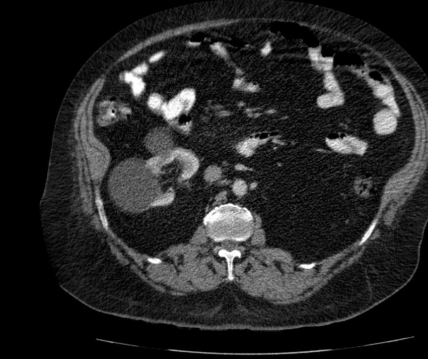 Nephroptosis with inguinal hernia containing perirenal fat (Radiopaedia 56632-63391 C 153).jpg