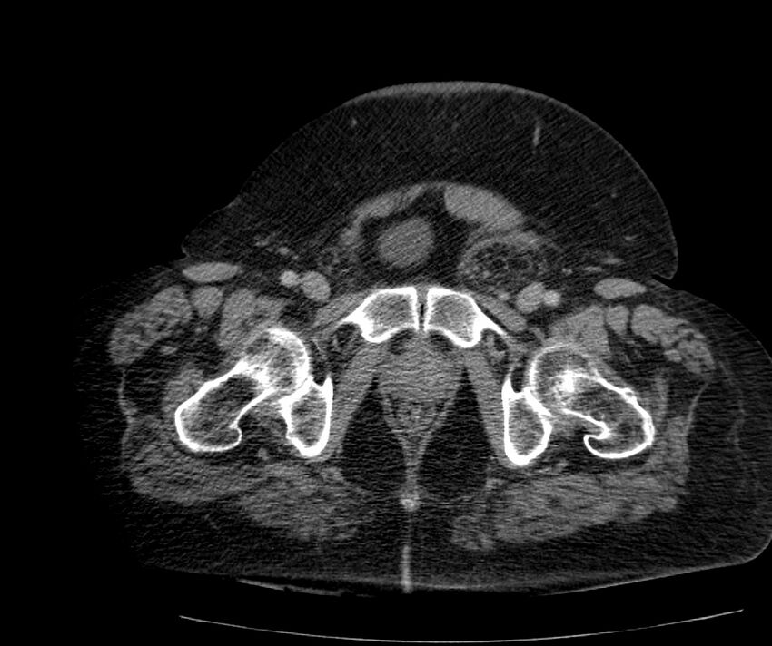 Nephroptosis with inguinal hernia containing perirenal fat (Radiopaedia 56632-63391 C 326).jpg