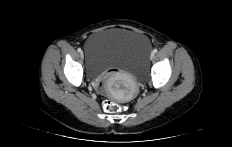 File:Non-puerperal uterine inversion (Radiopaedia 78343-91094 A 37).jpg