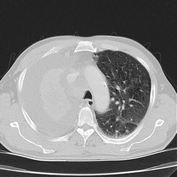 File:Non small-cell lung cancer (Radiopaedia 24467-24769 lung window 14).jpg