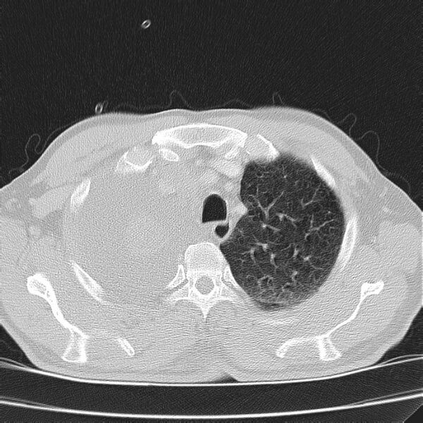 File:Non small-cell lung cancer (Radiopaedia 24467-24769 lung window 8).jpg