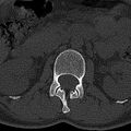 Normal CT lumbar spine (Radiopaedia 53981-60118 Axial bone window 20).jpg