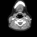 Normal CT of the neck (Radiopaedia 14575-14500 Axial C+ 40).jpg