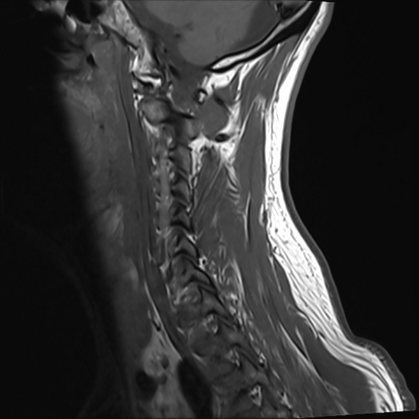 File:Normal MRI cervical spine (infection protocol) (Radiopaedia 53916-60039 Sagittal T1 12).png