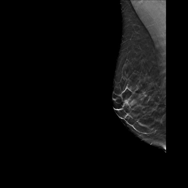 File:Normal breast mammography (tomosynthesis) and ultrasound (Radiopaedia 65325-74353 RMLO Tomo 25).jpeg