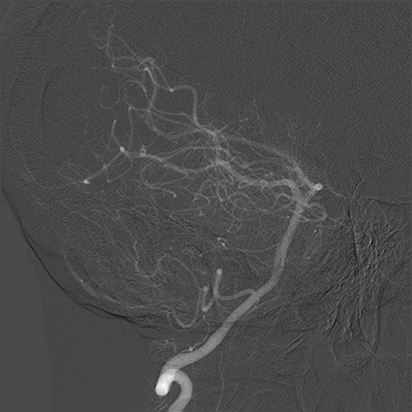 File:Normal cerebral angiogram (four vessel DSA) (Radiopaedia 41708-44649 O 8).png