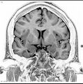 Normal coronal brain (Radiopaedia 6676-7910 B 18).jpg