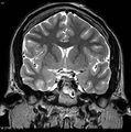 Normal coronal brain (Radiopaedia 6676-7910 Coronal T2 17).jpg