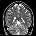 Normal coronal brain (Radiopaedia 6676-7910 Coronal T2 32).jpg