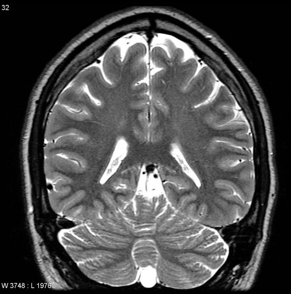File:Normal coronal brain (Radiopaedia 6676-7910 Coronal T2 32).jpg
