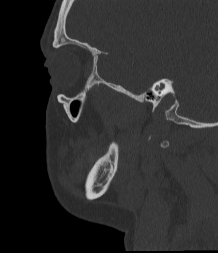 Normal facial bone CT (Radiopaedia 88742-105476 Sagittal bone window 50).jpg