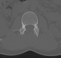 Normal lumbar spine CT (Radiopaedia 46533-50986 Axial bone window 21).png