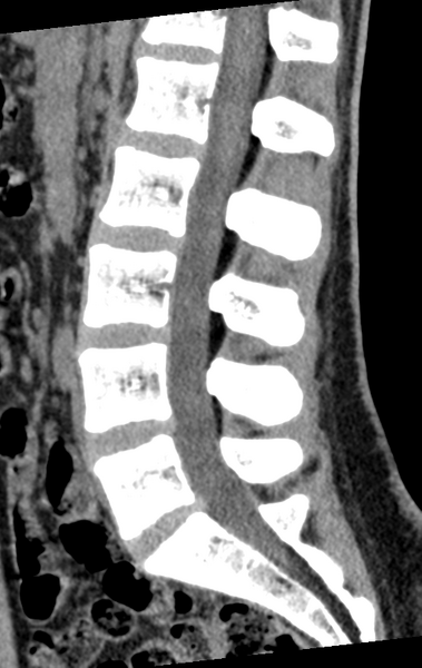 File:Normal lumbar spine CT (Radiopaedia 46533-50986 C 52).png