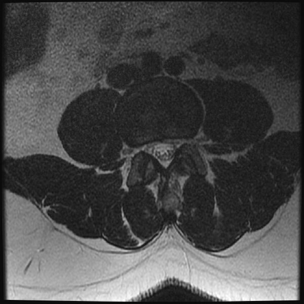 File:Normal lumbar spine MRI (Radiopaedia 43051-46311 Axial T2 15).jpg