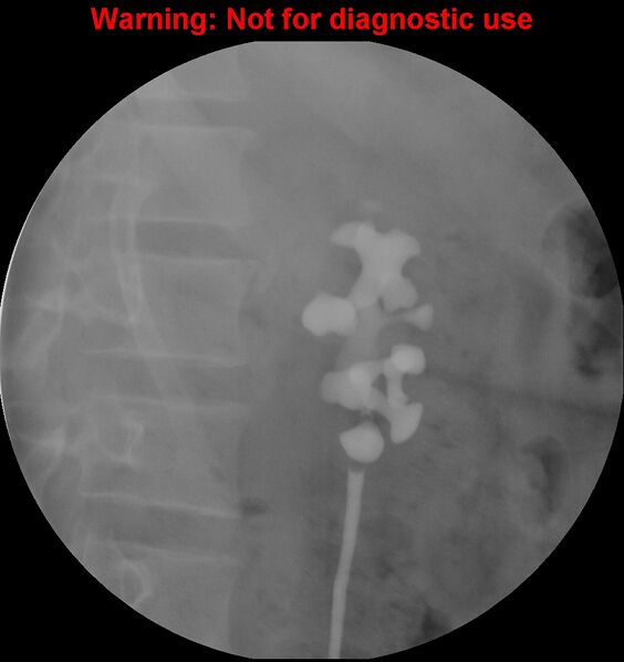File:Normal retrograde pyelography of a native and transplant kidney (Radiopaedia 40480-43054 Native kidney 3).jpg